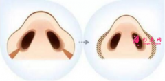 鼻翼縮小手術(shù)出血多嗎？