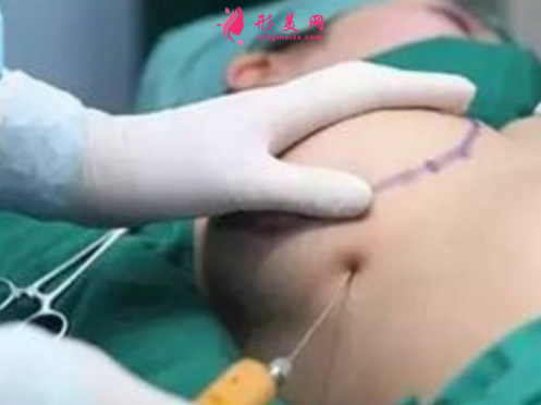 自體脂肪隆胸恢復(fù)期內(nèi)可以揉胸部嗎