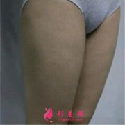 純脂醫(yī)療美容馮斌院長大腿抽脂案例效果分享
