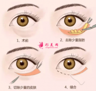 手術(shù)祛眼袋會有難看的疤痕嗎？