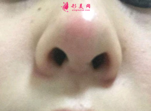 隆鼻失敗多久才能做修復(fù)手術(shù)