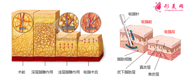上臂吸脂一般什么價(jià)位