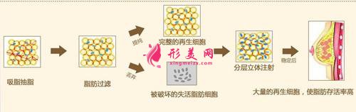 自身脂肪隆胸手術(shù)比假體好嗎