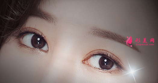 開內(nèi)眼角多久才能恢復(fù)自然