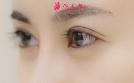 廣州埋線雙眼皮需要多少錢