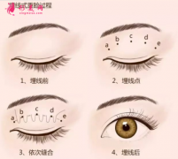 上海華美整型美容醫(yī)院埋線雙眼皮需要多少錢？