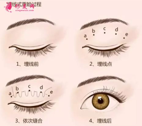 廣州埋線雙眼皮需要多少錢