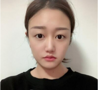 北京八大處靳小雷雙眼皮怎么樣？最近案例一覽|小仙女就此誕生!