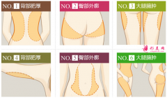 吸脂減肥手術(shù)有哪些優(yōu)勢(shì)？