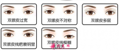 雙眼皮修復(fù)常見的類型