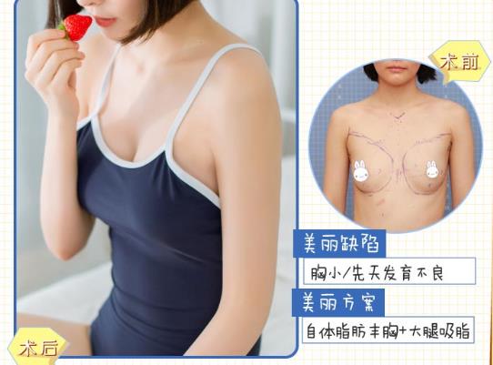 上海九院自體脂肪隆胸價(jià)格是多少?2022價(jià)目表分享~ 上海九院自體脂肪隆胸價(jià)格是多少?2022價(jià)目表分享~