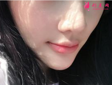 注射瘦臉針會有風險嗎