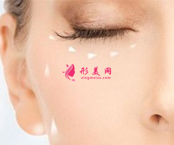 手術(shù)祛眼袋多久恢復(fù)自然