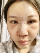 重慶整形醫(yī)院哪家做鼻子比較好？小姐姐做的鼻綜合手術(shù)案例分享