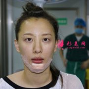 廣州韓妃整形醫(yī)院硅膠墊下巴怎么樣？真實案例分享