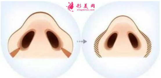 鼻翼縮小術(shù)后怎么快速恢復(fù)