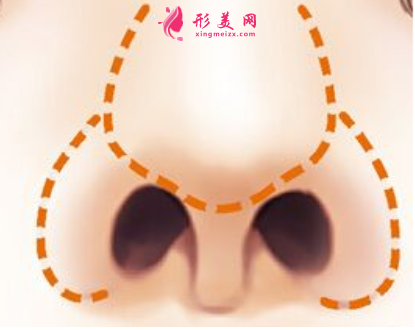 鼻翼縮小術(shù)后怎么快速恢復(fù)