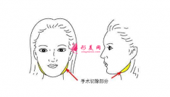 磨骨瘦臉手術(shù)多少錢？術(shù)后6大注意事項要謹(jǐn)記