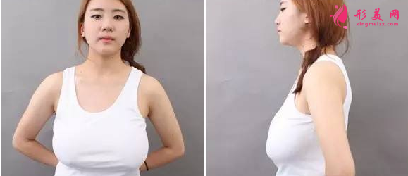 巨乳縮小術(shù)后多久能恢復(fù)