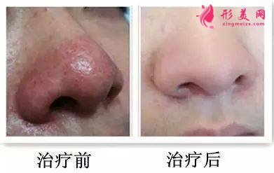 根治酒糟鼻—激光療法