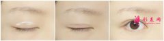 成都雙眼皮失敗修復(fù)價(jià)格是多少？