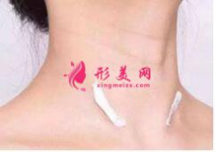 激光祛斑的效果如何？為什么肌膚會(huì)出現(xiàn)反黑現(xiàn)象?