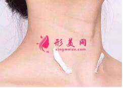 激光祛斑的效果如何?為什么肌膚會(huì)出現(xiàn)反黑現(xiàn)象?