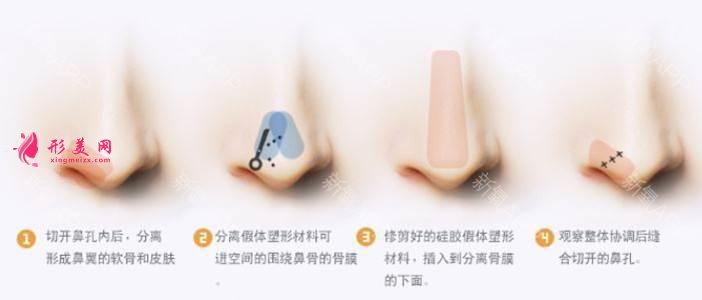 鼻尖整形的價(jià)格
