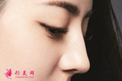 自體軟骨隆鼻有什么缺點