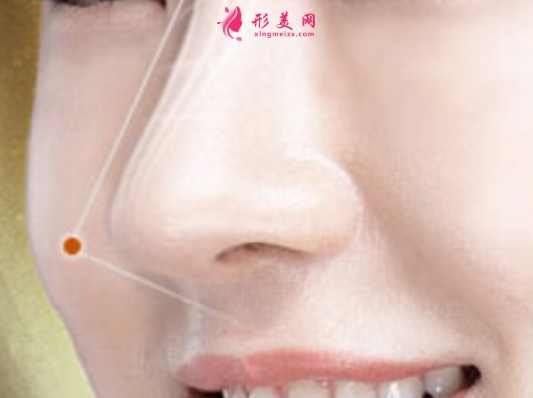 自體軟骨隆鼻的優(yōu)點(diǎn)有哪些