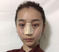北京彤美醫(yī)療美容醫(yī)院埋線雙眼皮+鼻綜合整形手術(shù)效果圖對(duì)比照