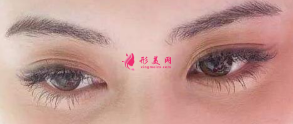 雙眼皮手術(shù)后怎么快速恢復(fù)