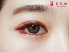 開眼角常見的手術(shù)方法？術(shù)后需要注意什么？