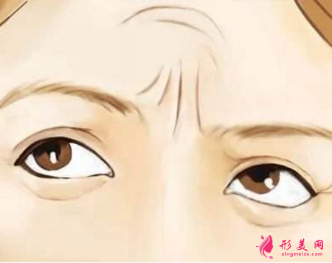如何去除抬頭紋
