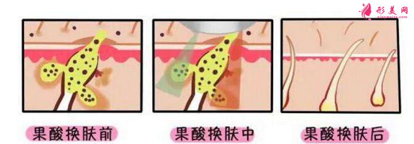 果酸換膚是什么