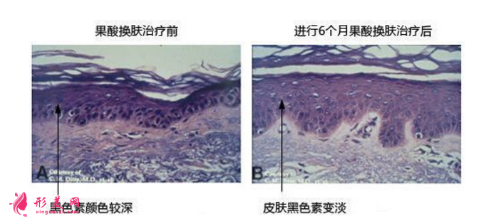 果酸換膚是什么