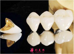 烤瓷牙材料哪種比較好？種類價(jià)格~