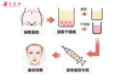 自體脂肪填充淚溝恢復期多少天？有什么注意事項