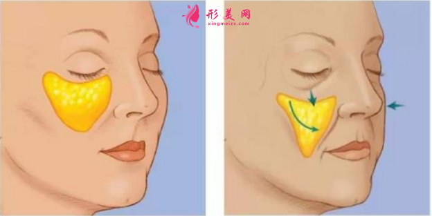 自體脂肪填充淚溝