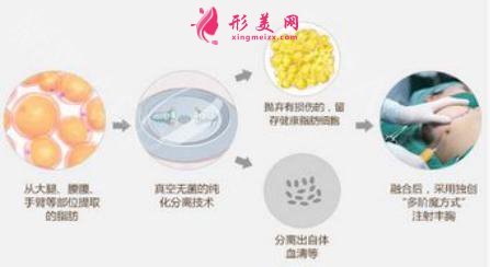自身脂肪隆胸手術(shù)比假體好嗎