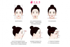 自體脂肪豐下巴會全部吸收了嗎?