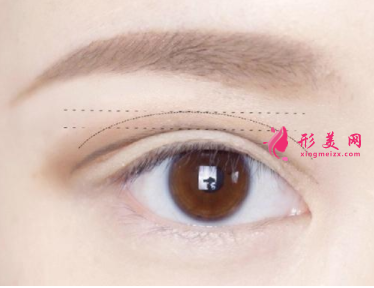 雙眼皮手術(shù)是局麻還是全麻