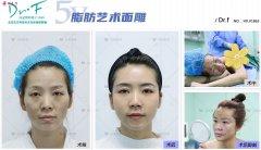 馮斌做吸脂手術(shù)需要多少費(fèi)用？