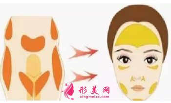自體脂肪移植