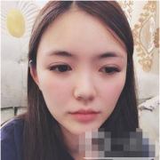  武漢媄妲（原武漢美天）醫(yī)療美容隆鼻怎么樣？附隆鼻術(shù)后反饋