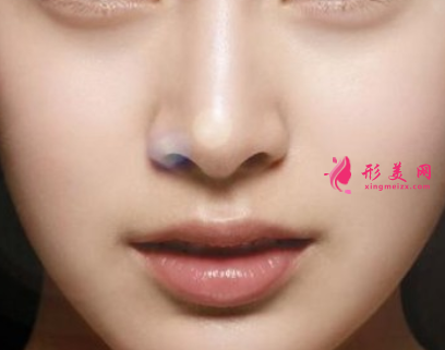 什么叫自體軟骨隆鼻