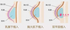 假體隆胸后可以喂母乳么?