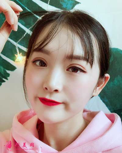 去佛山華美找梁宗建院長做全切雙眼皮手術(shù)后1個月