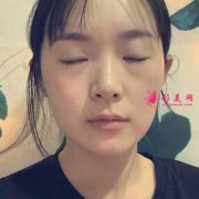 佛山華美找梁宗建院長做全切雙眼皮真實(shí)體驗(yàn)分享