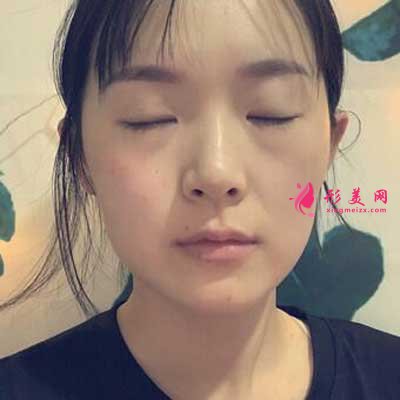 分享我去佛山華美找梁宗建院長做全切雙眼皮手術(shù)前